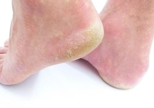 running injuries