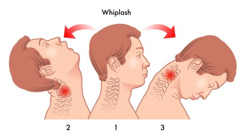 inversion tables for neck pain and whiplash