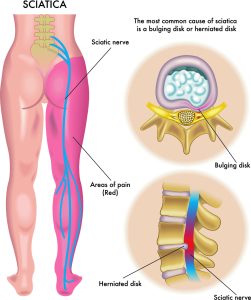 Medical illustration of symptoms of sciatica